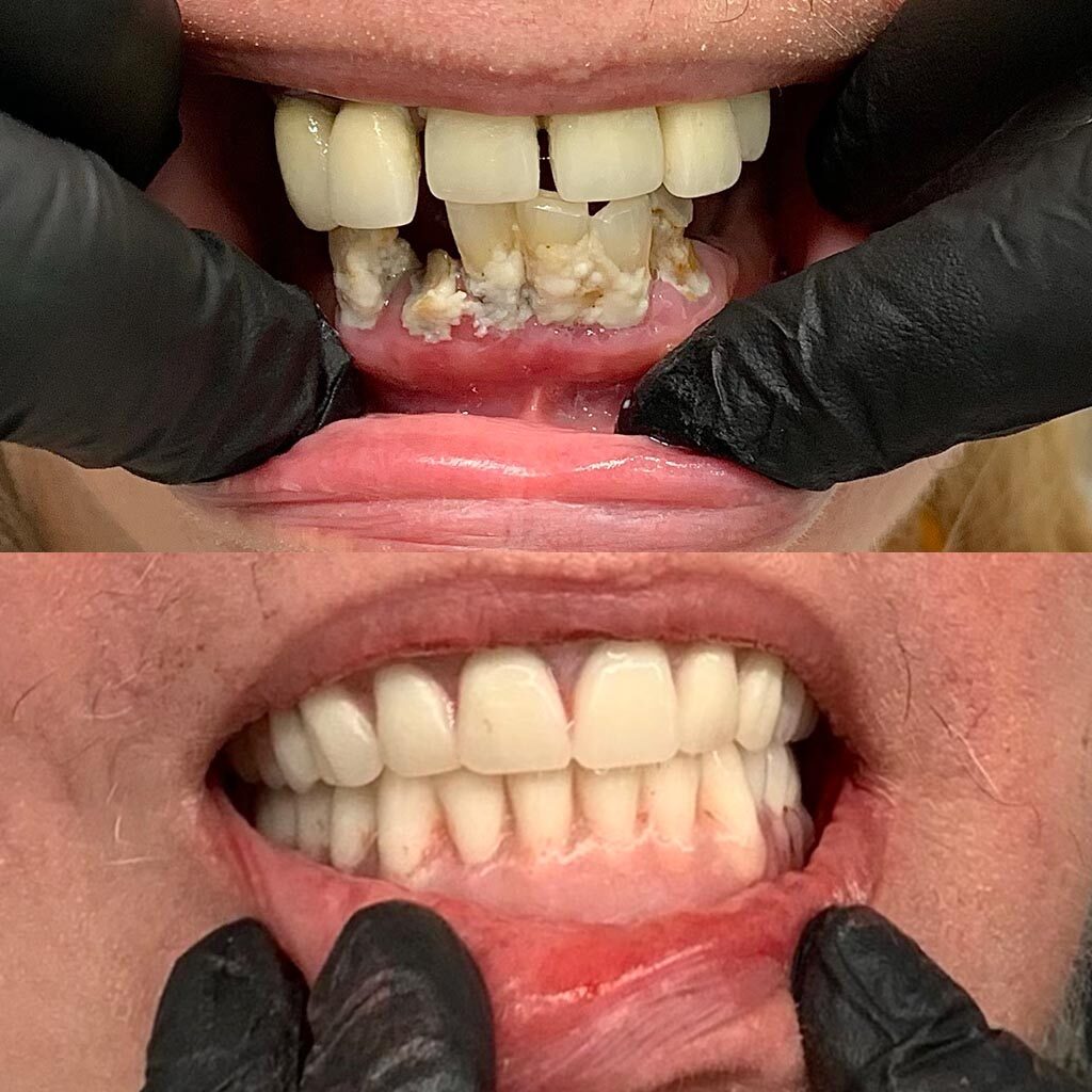 before and after new