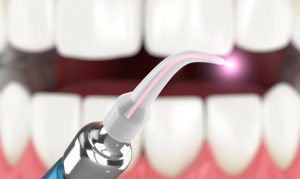 Laser Dentistry