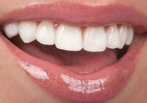 Dental Veneers