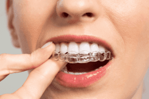 Clear Aligners