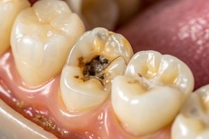 Tooth decay close up: cavity dental problem